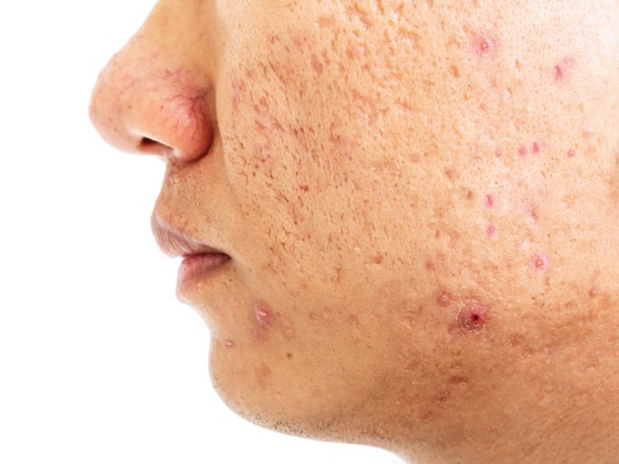 scar-treatment-A S Rao Nagar-Secunderabad